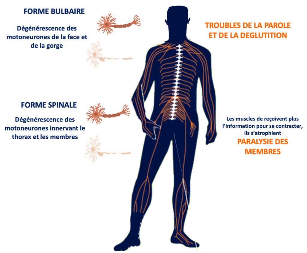 Symptoms, progression and life expectancy with Charcot’s disease ...