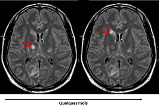 Deux IRM du même sujet montrant la dissémination dans l'espace (gauche) avec des lésions inflammatoires de la substance blanche périventriculaire et juxtacorticale et la dissémination dans le temps (droite) avec des lésions de différents âges (prise de contraste).