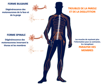 Dégénérescence des motoneurones