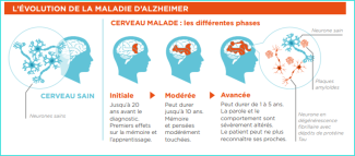 L'évolution de la maladie d'Alzheimer