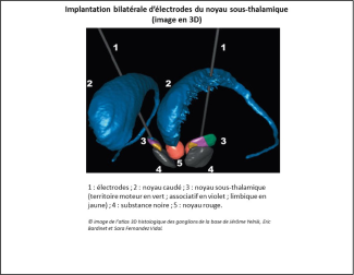 Implantation bilatérale d'électrodes du noyau sous-thalamique