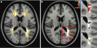 First demonstration of the neuroprotective effect of remyelination in multiple sclerosis patients