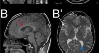 MRI images of a SPG26 affected subject, with an enlarged corpus callosum in B (red arrow) and a cerebral atrophy in B’, (white arrow).