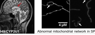 Bottom line, from left to right : atrophy of the corpus callosum and of the cerebellum, abnormal structures of the mitochondrial network.