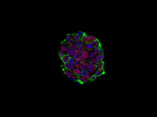 Guichet, Pierre-Olivier / Glioblastome © Institut du Cerveau