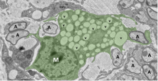 Macrophage (M, vert) dans une lésion de démyélinisation 