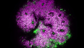 Organoïde de cortex humain. Les cellules progénitrices corticales apparaissent en blanc, et les nouveaux neurones en vert. Les autres cellules sont marquées en magenta en arrière-plan.