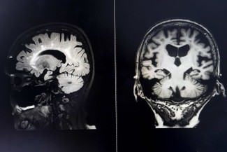 brain MRI for education Dementia Mix type stroke VaD