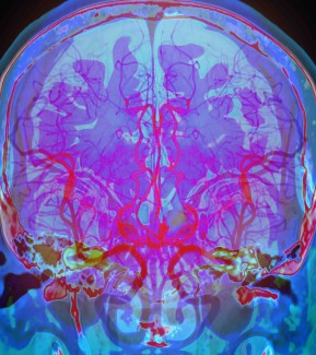 Hypertension intracrânienne idiopathique