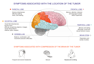Symptoms of Brain Tumors